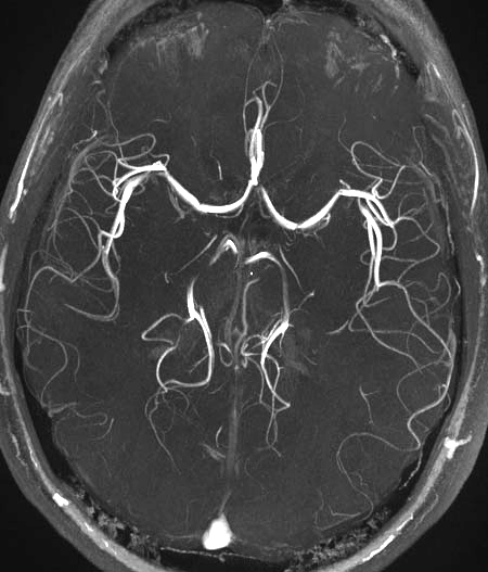 Risonanza magnetica del cervello vista dall’alto: le arterie appaiono come linee bianche ramificate su sfondo scuro